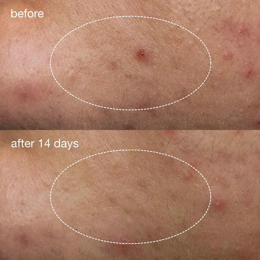 Acne & Blemish Control