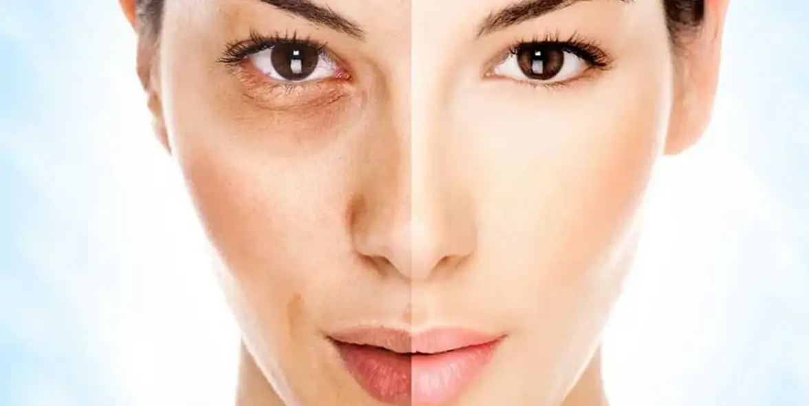Dark Spot & Hyperpigmentation Therapy